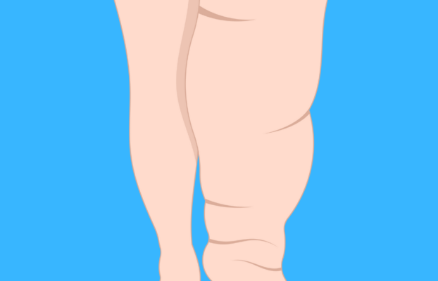 Lipedema: Un Percorso Verso il Benessere
